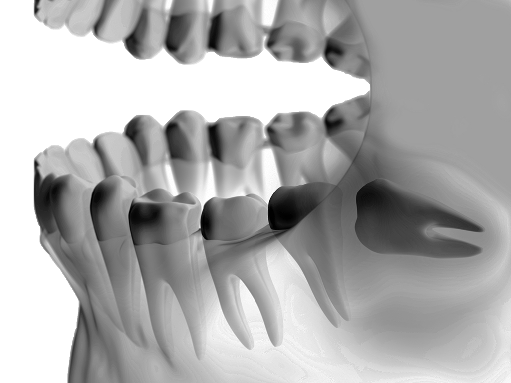 Wisdom Teeth Removal Oral Surgeon In Marietta Ga